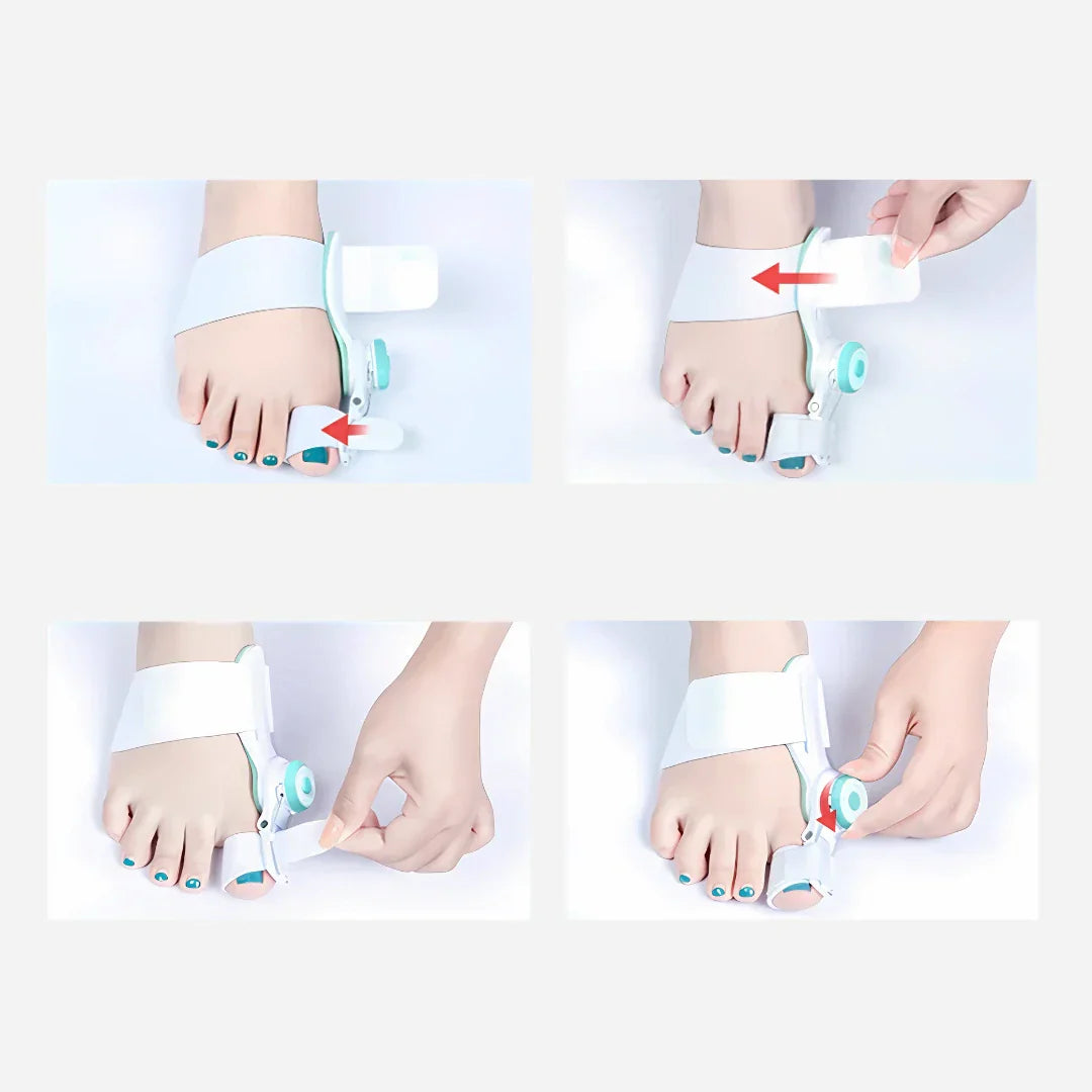 Solemarket | Justerbar tåkorrektor til hallux valgus og bunion korrektion